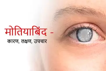 1714368428_Cataract--मोतियाबिंद----कारण,-लक्षण,-उपचार-thumbnail